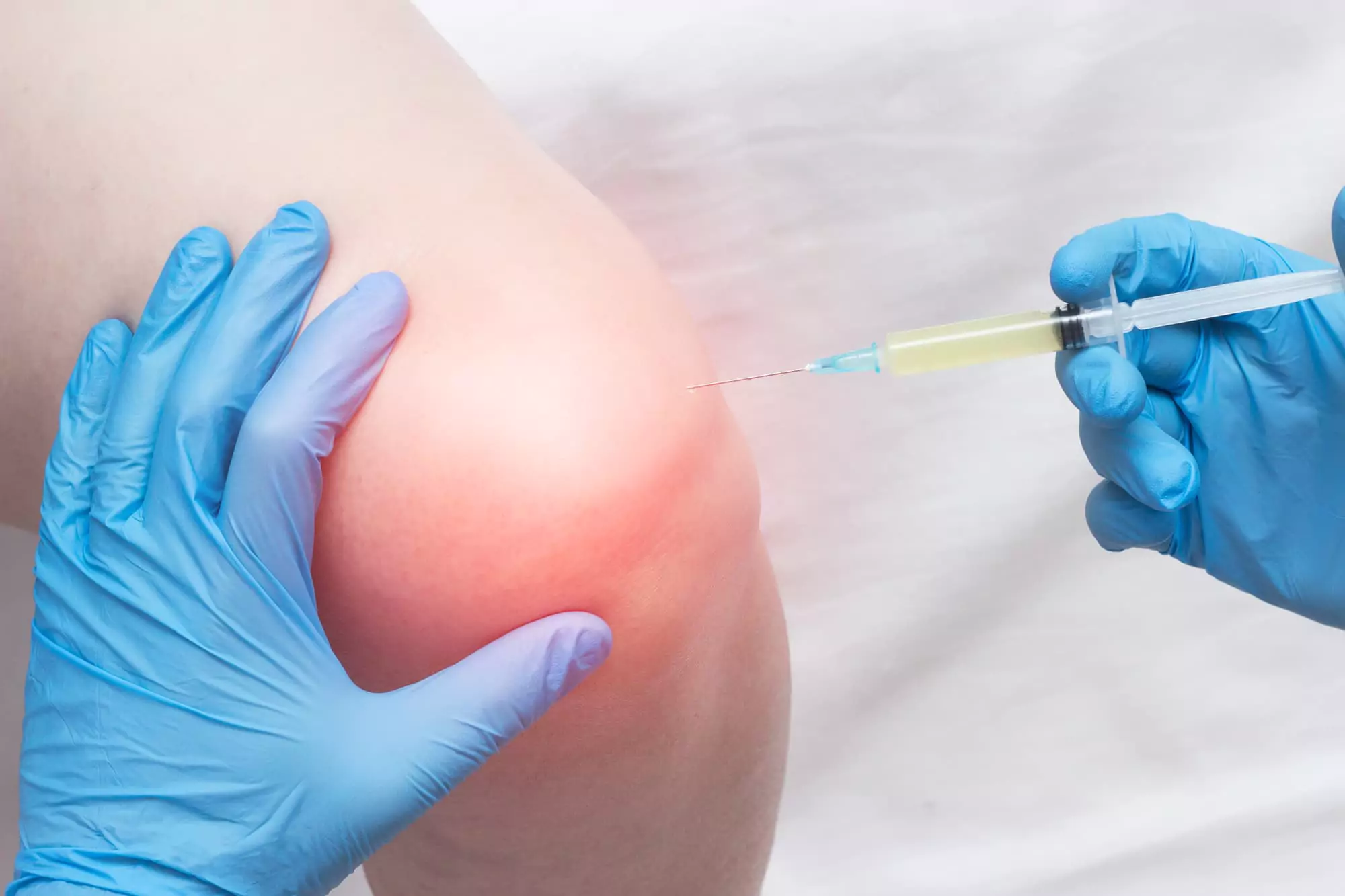 Knee Gel Injections for Osteoarthritis: The Best Products and Procedures | Blog Post Archives | Doctor Medica Knee Gel Injections for Osteoarthritis: The Best Products and Procedures | Blog Post Archives | Doctor Medica