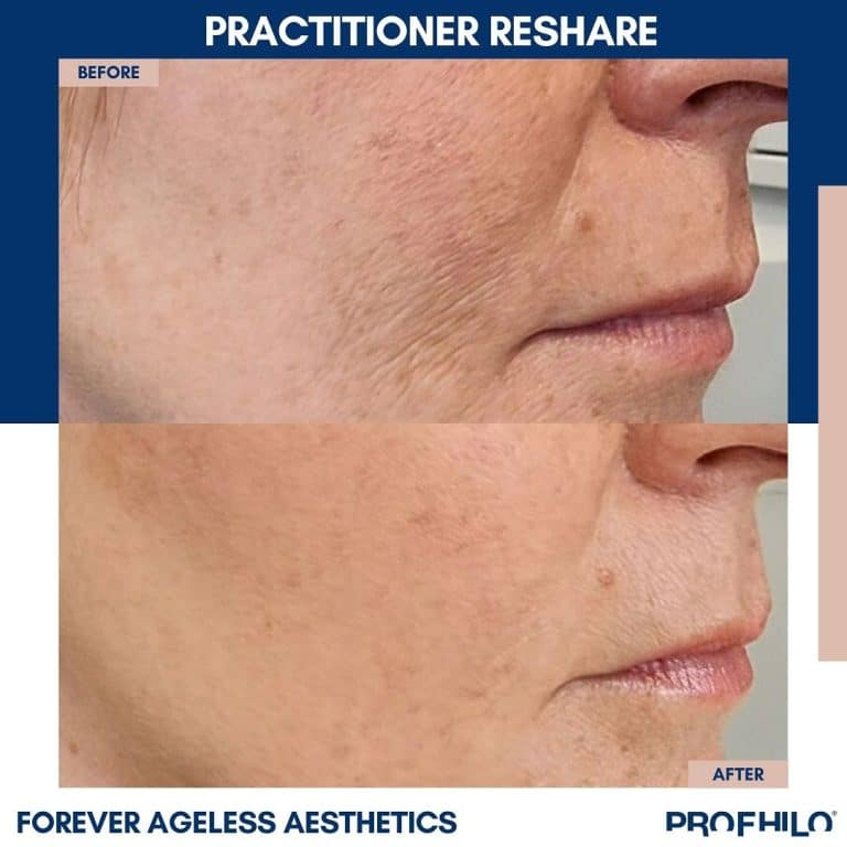 Profhilo Face Injection Pattern Profhilo Injections | Before and After | Doctor Medica