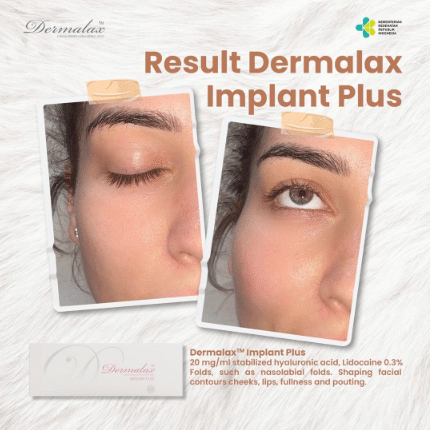 Dermalax Implant Plus used for facial contouring.