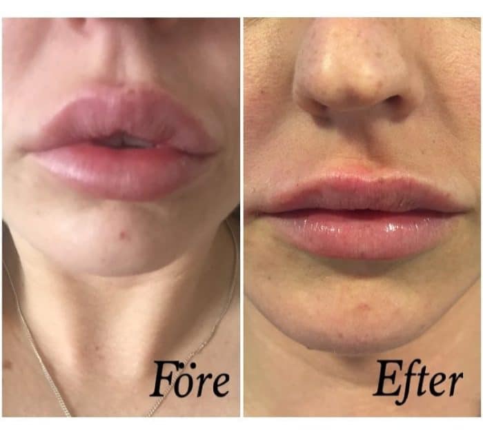 Before and after using Filorga Fillers for lip augmentation.