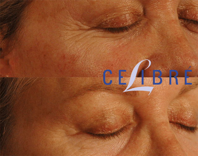 Treating crow's feet with Botox injections.