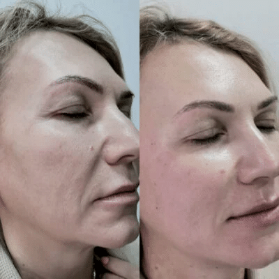 Jalupro HMW for overall facial rejuvenation.