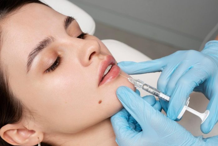 A female patient receives Dysport injections for a lip flip procedure.