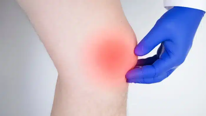 Knee swelling. 