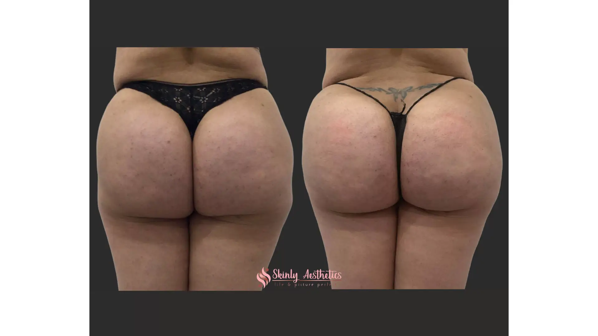 Butt injections.