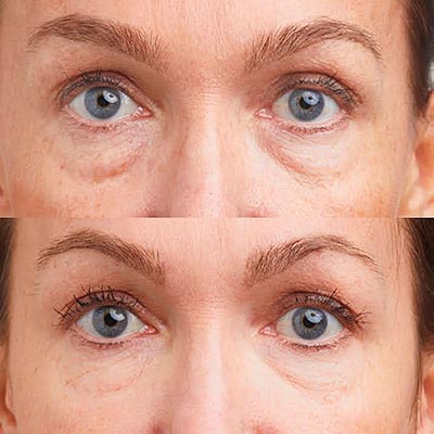 mesotherapy skin boosters sunekos -results, before after