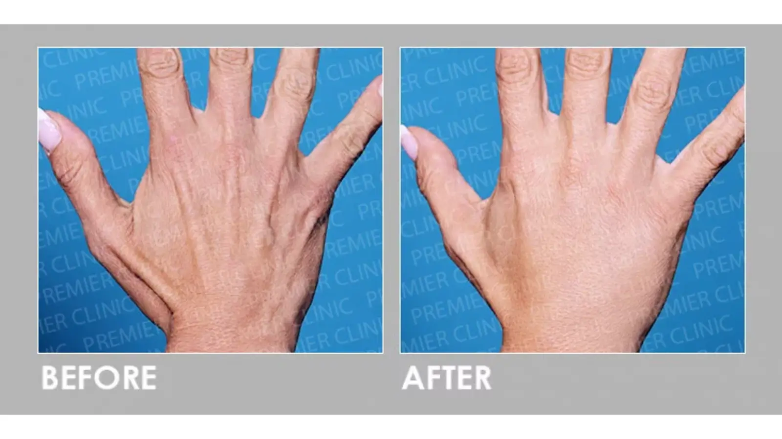 Sculptra hands treatment before and after.