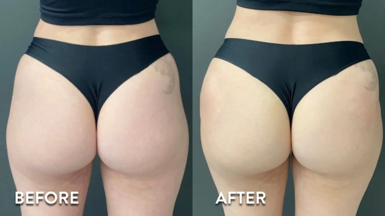 Before and after of Sculptra.