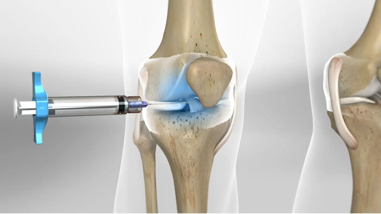 Knee injections.