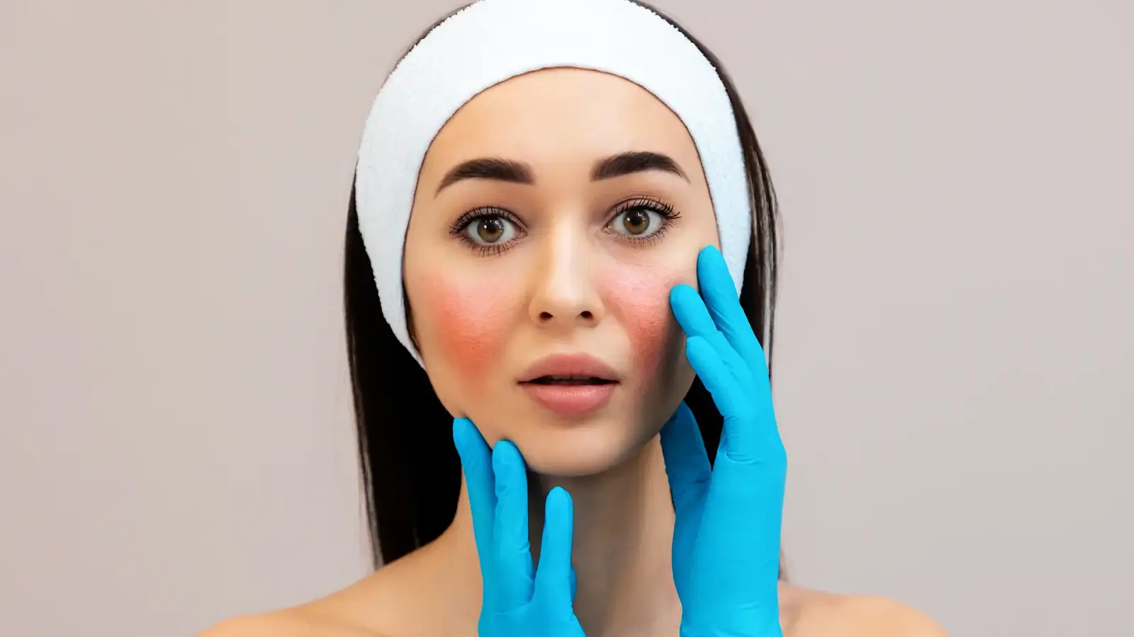 Facial redness.