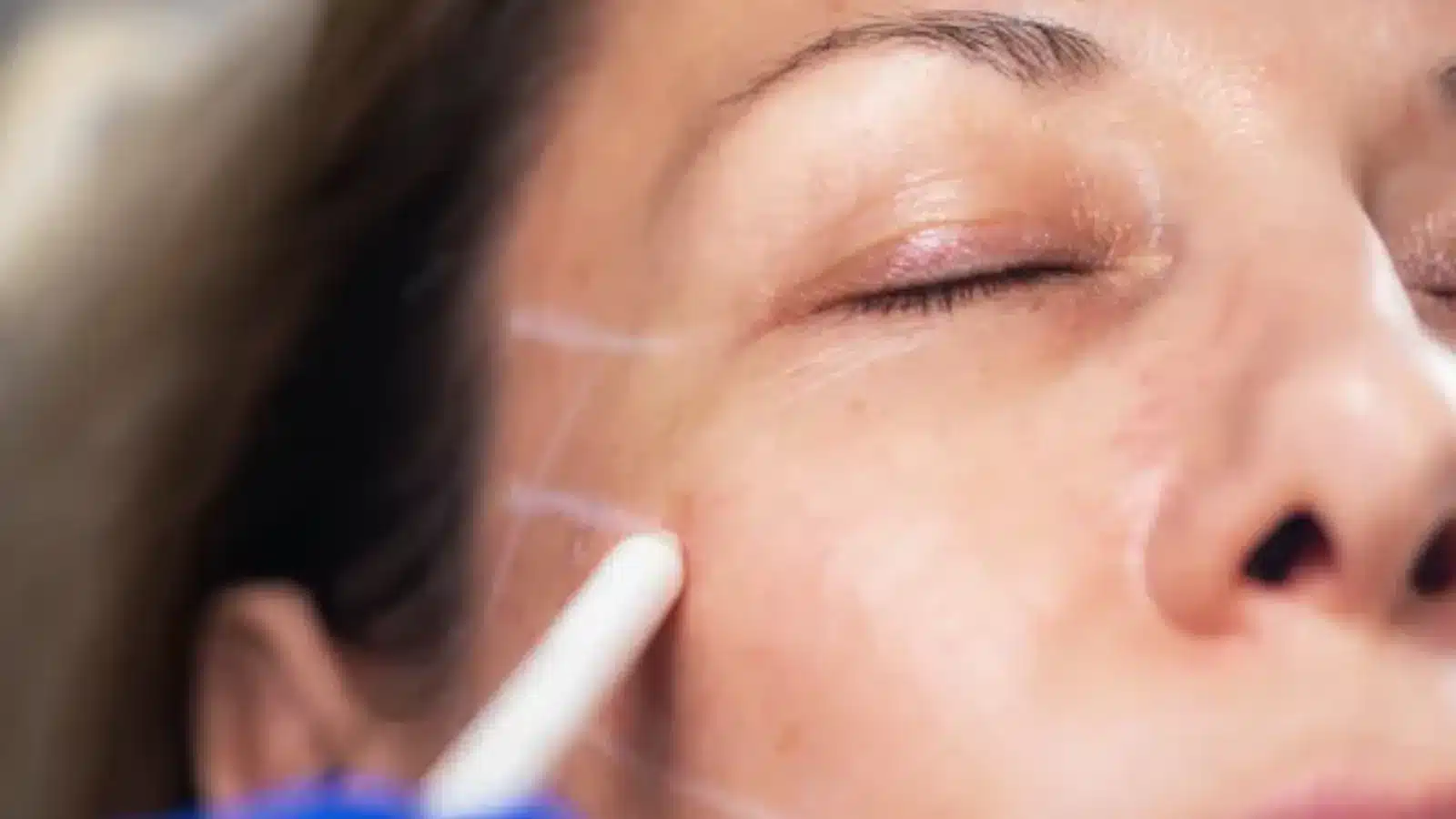 Healthcare professional marking treatment areas before procedure.