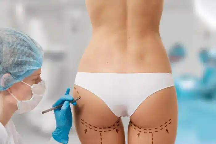 body contouring