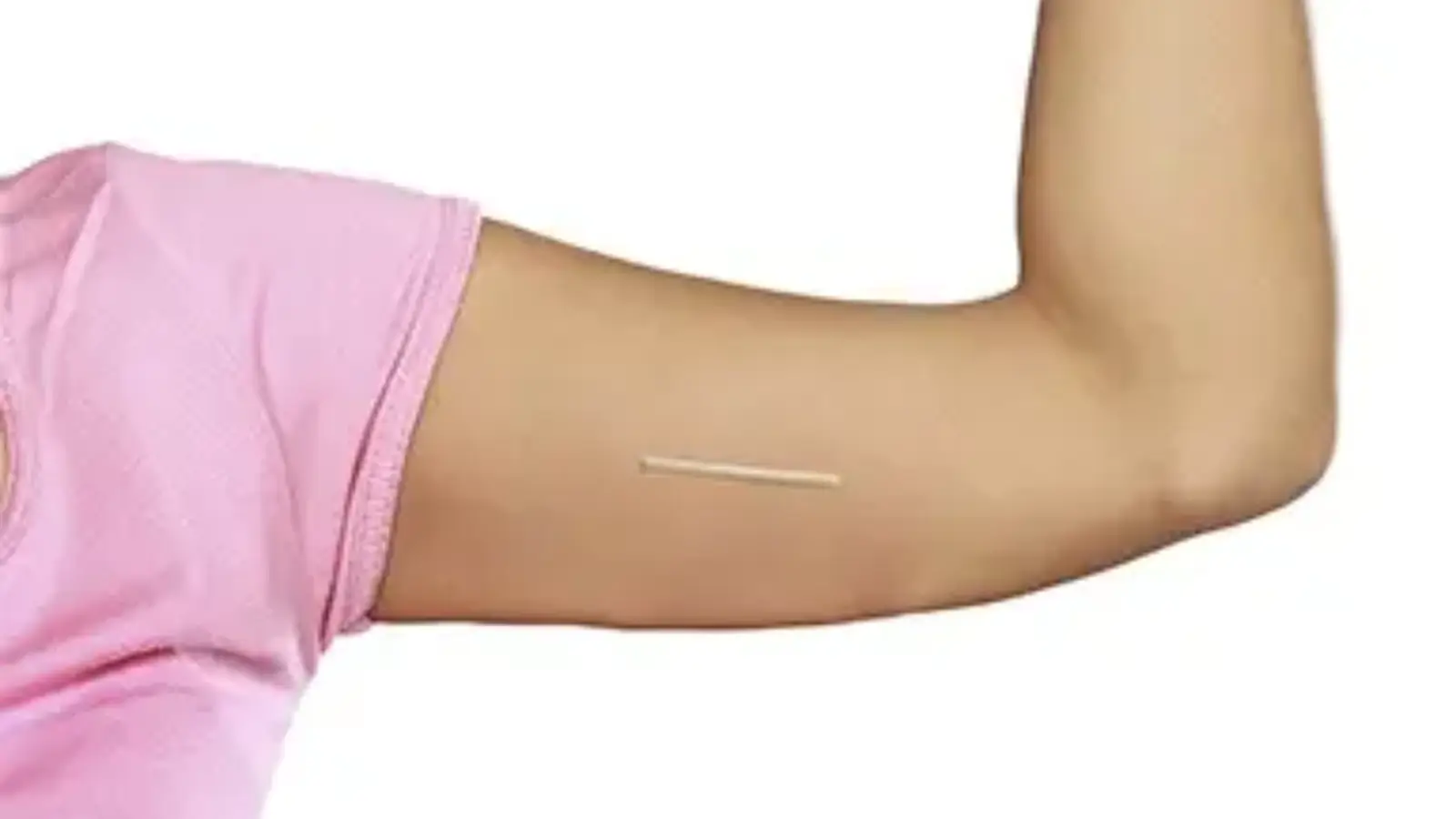 Removal of Nexplanon implant.