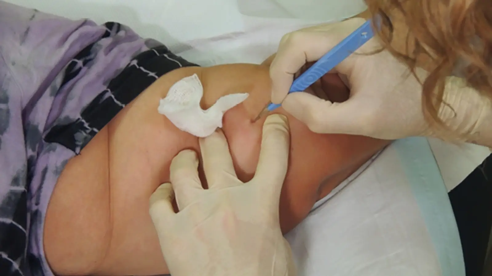 A professional removing Nexaplanon.