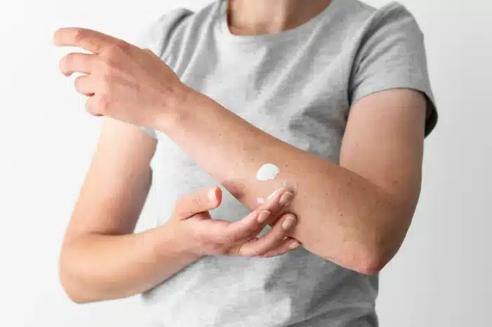 Person putting cream on burns.