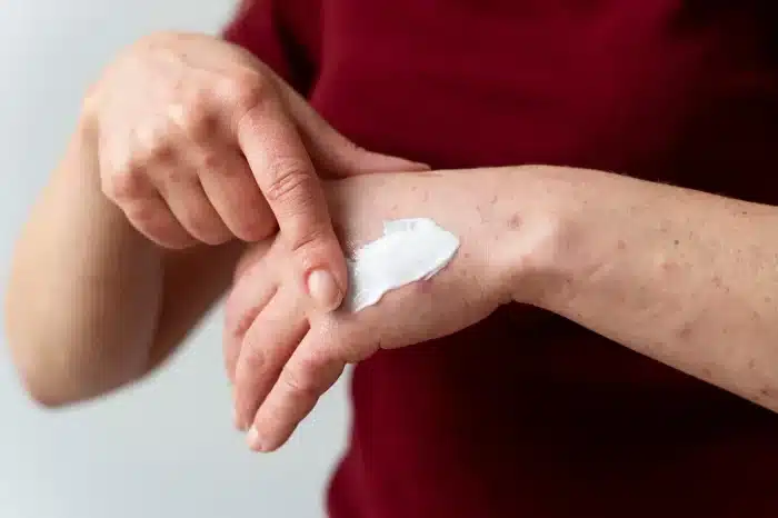 Person putting cream on burns.