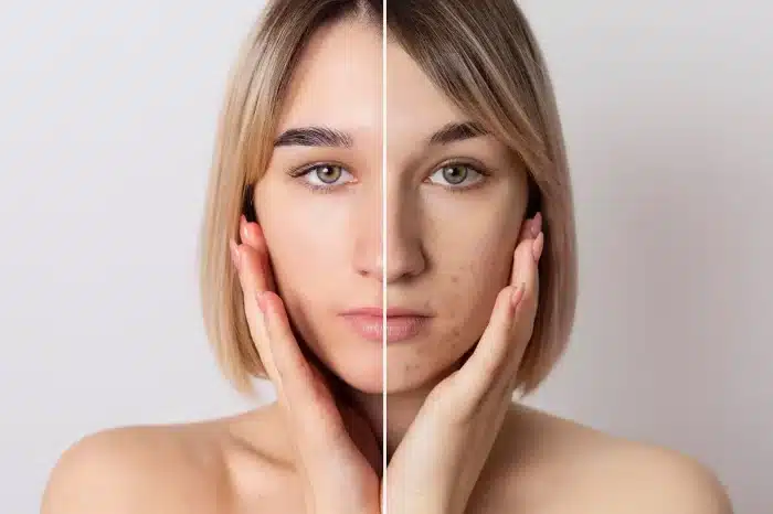 A woman with short, straight blonde hair touches her face. The image is split down the middle, showing clear, even skin on the left side and visible acne and redness on the right side.