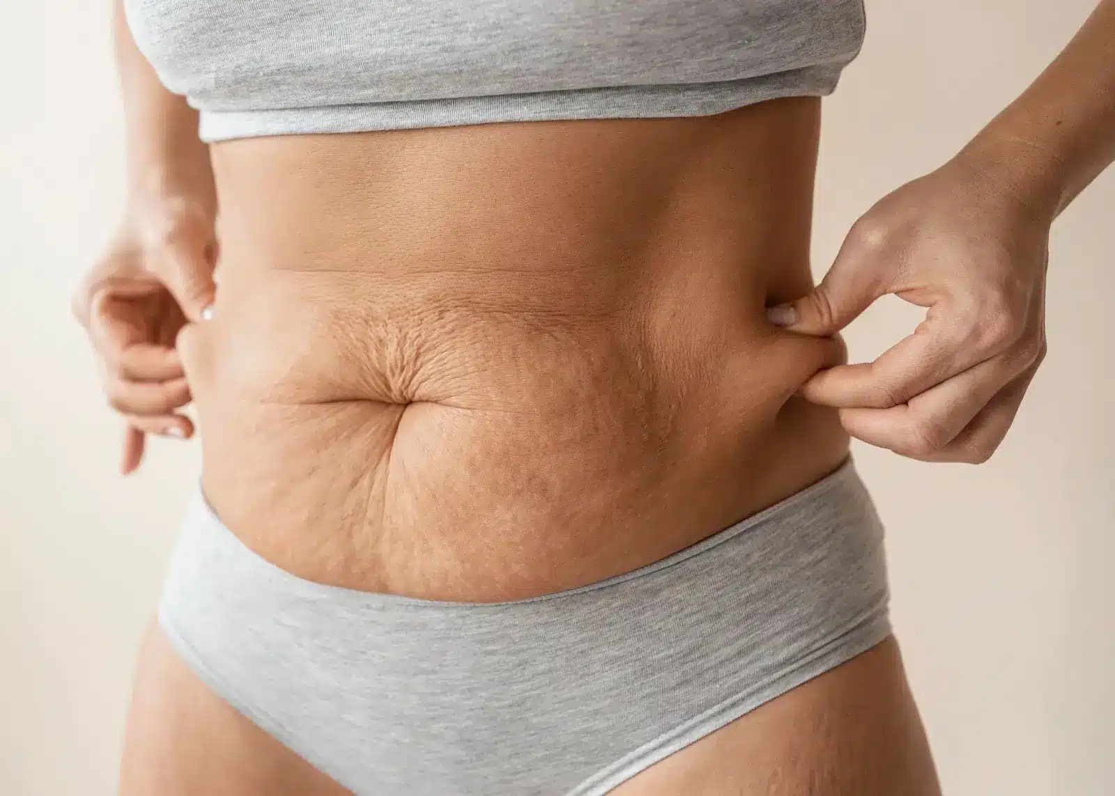 Person with cellulite in stomach. 