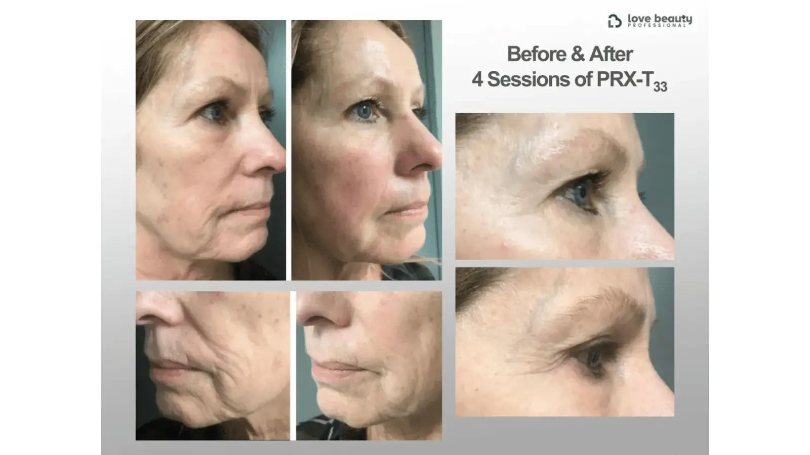 Photo Gallery PRX T33 Results for Aging