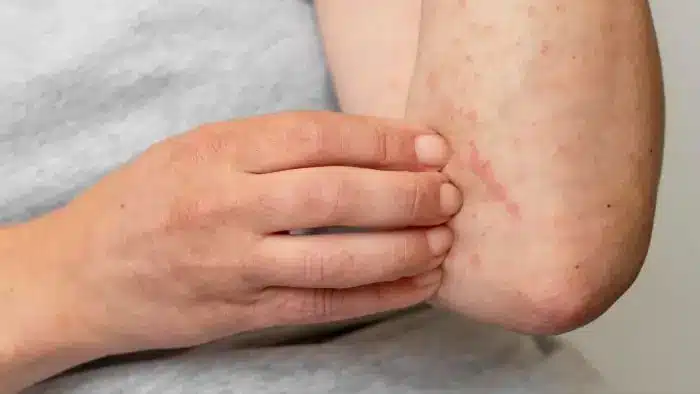 A person with allergies after an Evenity treatment.